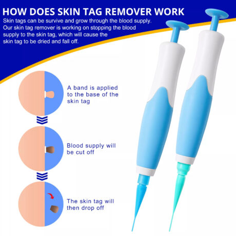 ALIVER 2in1 Gentle Skin Tag Removal Kit